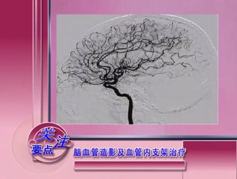 《滄州電視門診》腦血管造影及血管內(nèi)支架治療